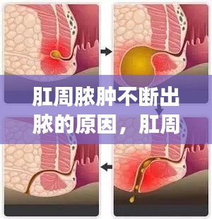 肛周脓肿不断出脓的原因，肛周脓肿天天流脓怎么办 